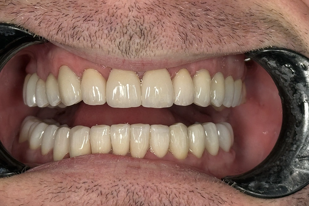 Cosmetic veneers after treatment at TRU Dentistry SoCo in South Austin, TX