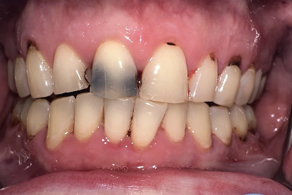 Cosmetic veneers before treatment at TRU Dentistry SoCo in South Austin, TX