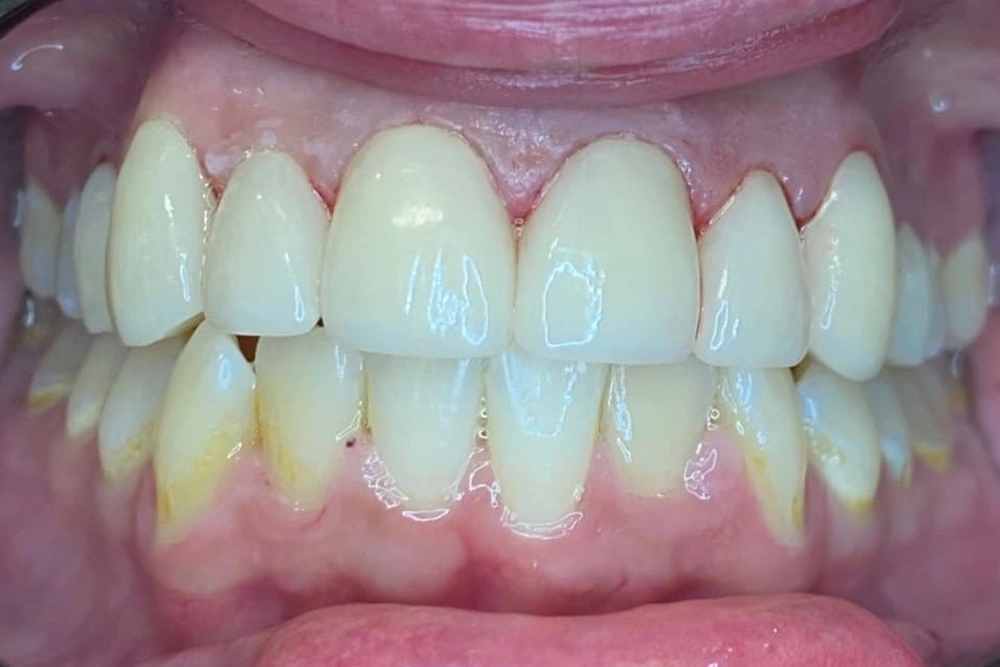 Dental crowns after treatment at TRU Dentistry SoCo in South Austin, TX