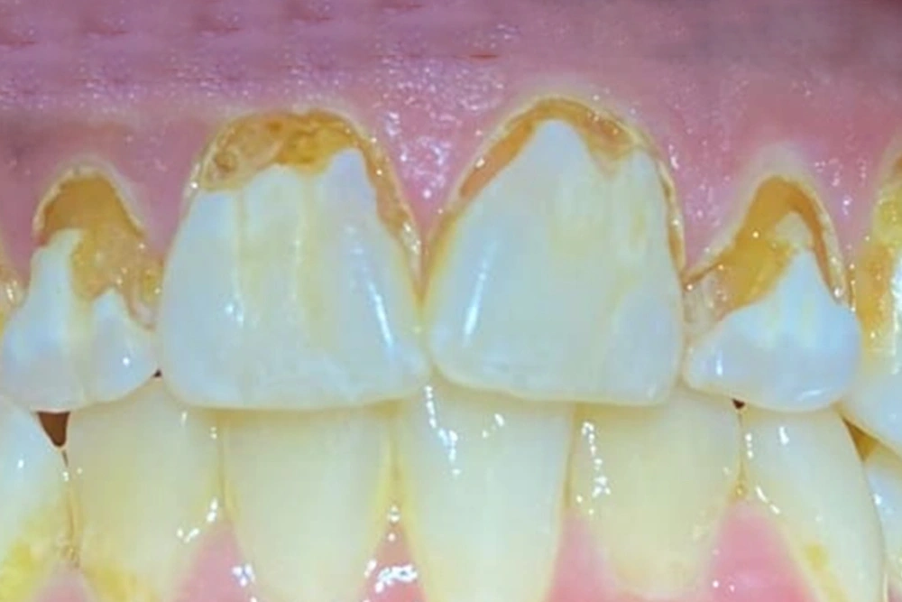 Dental crowns before treatment at TRU Dentistry SoCo in South Austin, TX