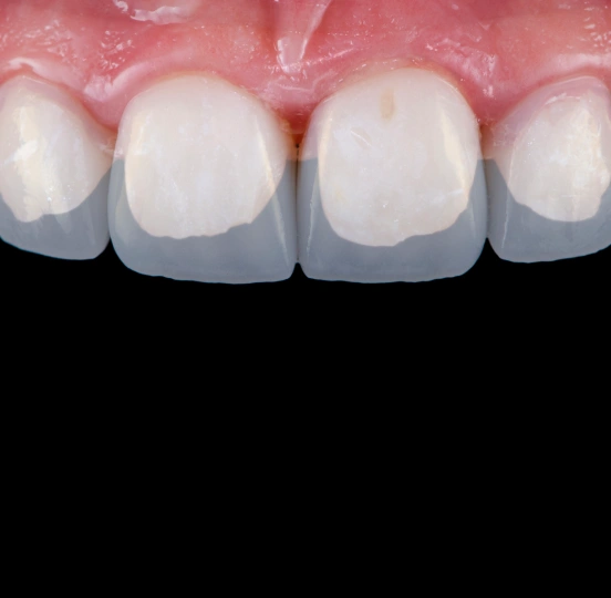 Close-up of front teeth before dental bonding treatment at TRU Dentistry SoCo in South Austin, TX