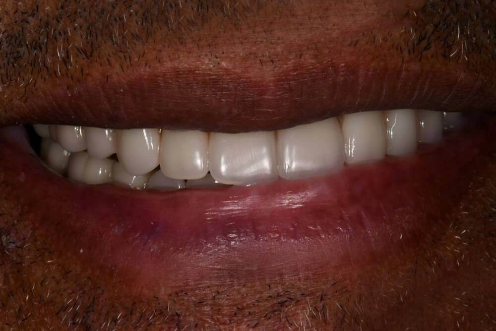 Dentures after treatment at TRU Dentistry SoCo in South Austin, TX