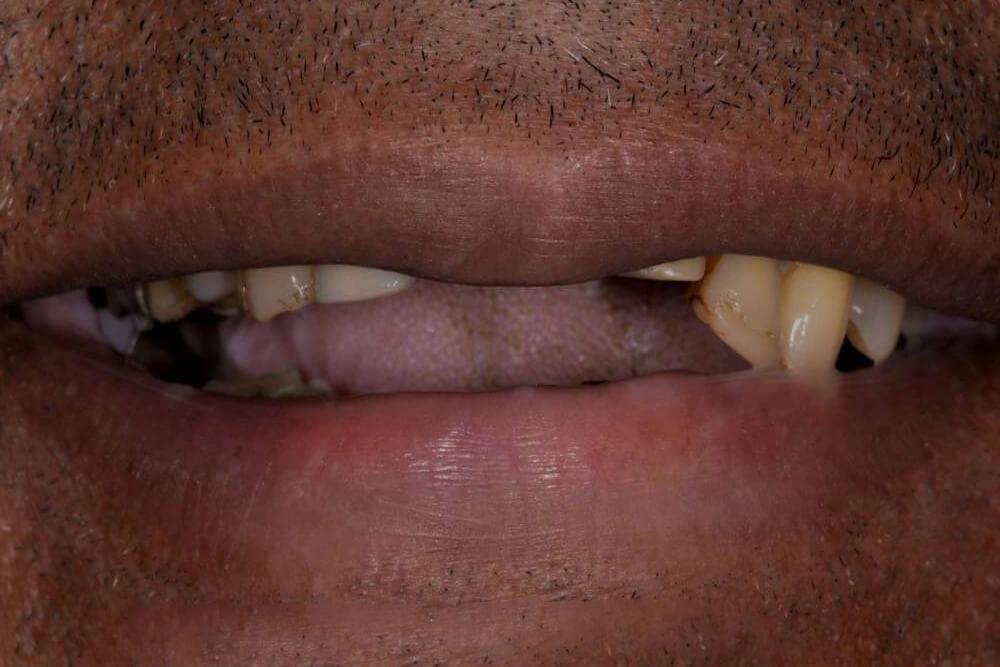 Dentures before treatment at TRU Dentistry SoCo in South Austin, TX