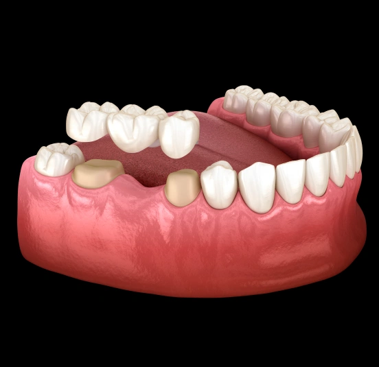 3D illustration of a dental bridge replacing missing teeth at TRU Dentistry SoCo in South Austin, TX
