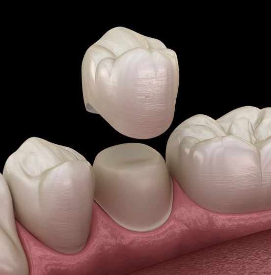 3D illustration of a dental crown being placed on a tooth at TRU Dentistry SoCo in South Austin, TX