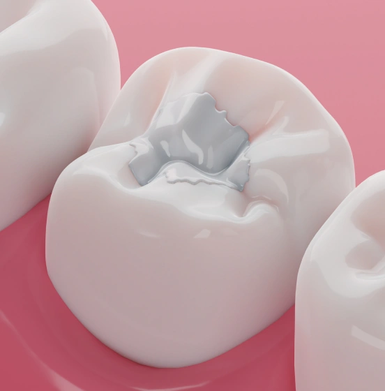 3D illustration of a tooth-colored composite dental filling at TRU Dentistry SoCo in South Austin, TX
