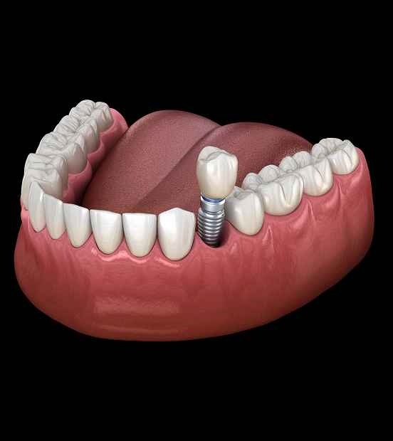 3D illustration of a dental implant replacing a missing tooth at TRU Dentistry SoCo in South Austin, TX