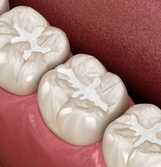 3D illustration of dental sealants protecting molars from decay at TRU Dentistry SoCo in South Austin, TX