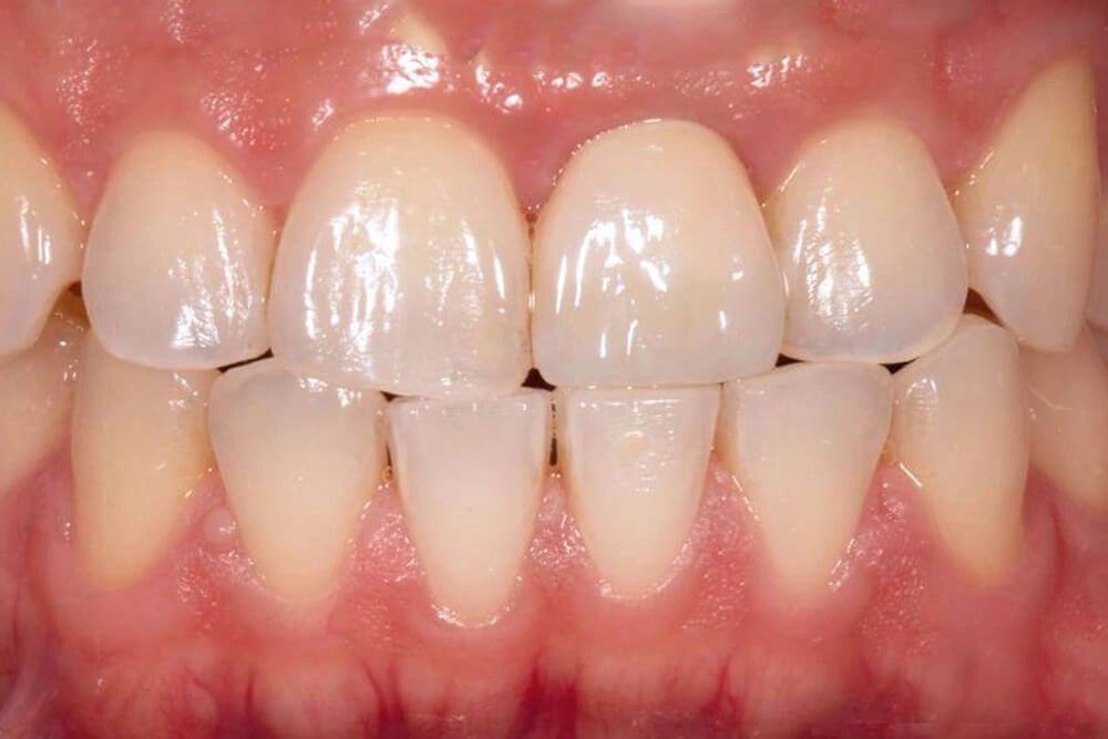 Dental implant after treatment at TRU Dentistry SoCo in South Austin, TX