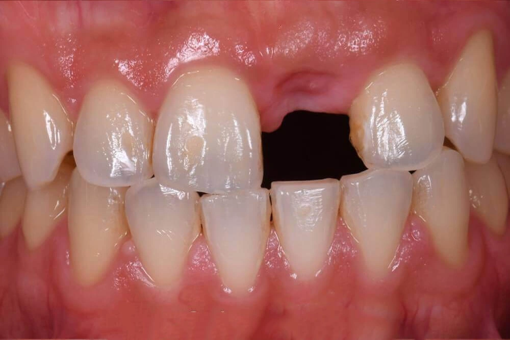 Dental implant before treatment at TRU Dentistry SoCo in South Austin, TX