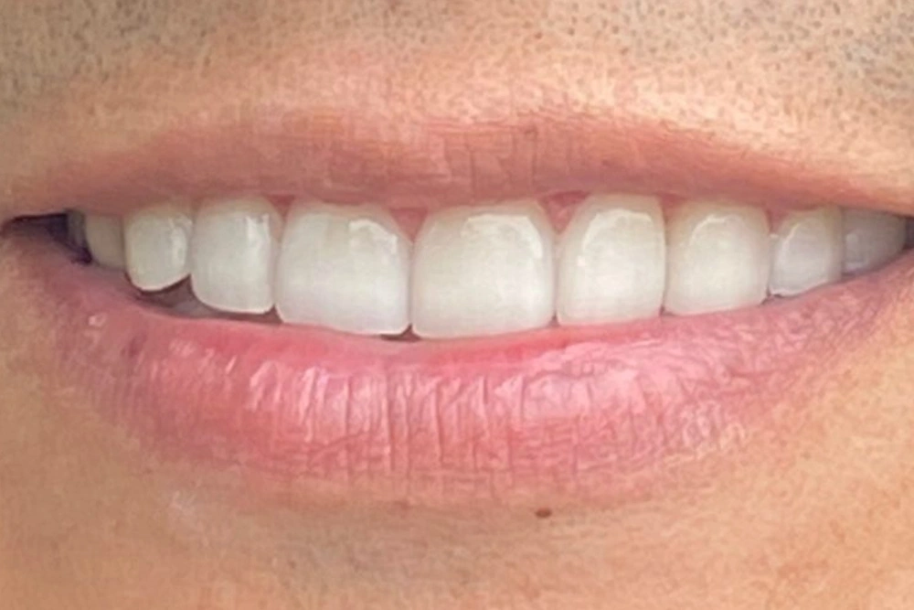 Dental implants, crowns, and bridges after treatment at TRU Dentistry SoCo in South Austin, TX