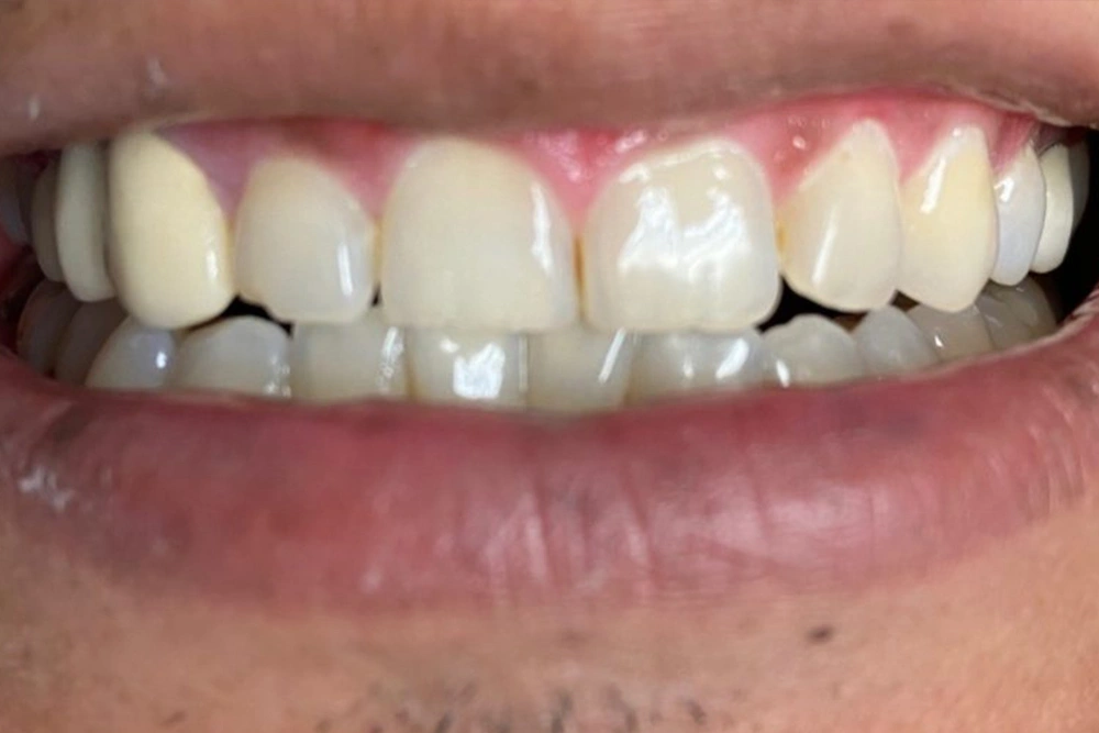 Dental implants, crowns, and bridges before treatment at TRU Dentistry SoCo in South Austin, TX