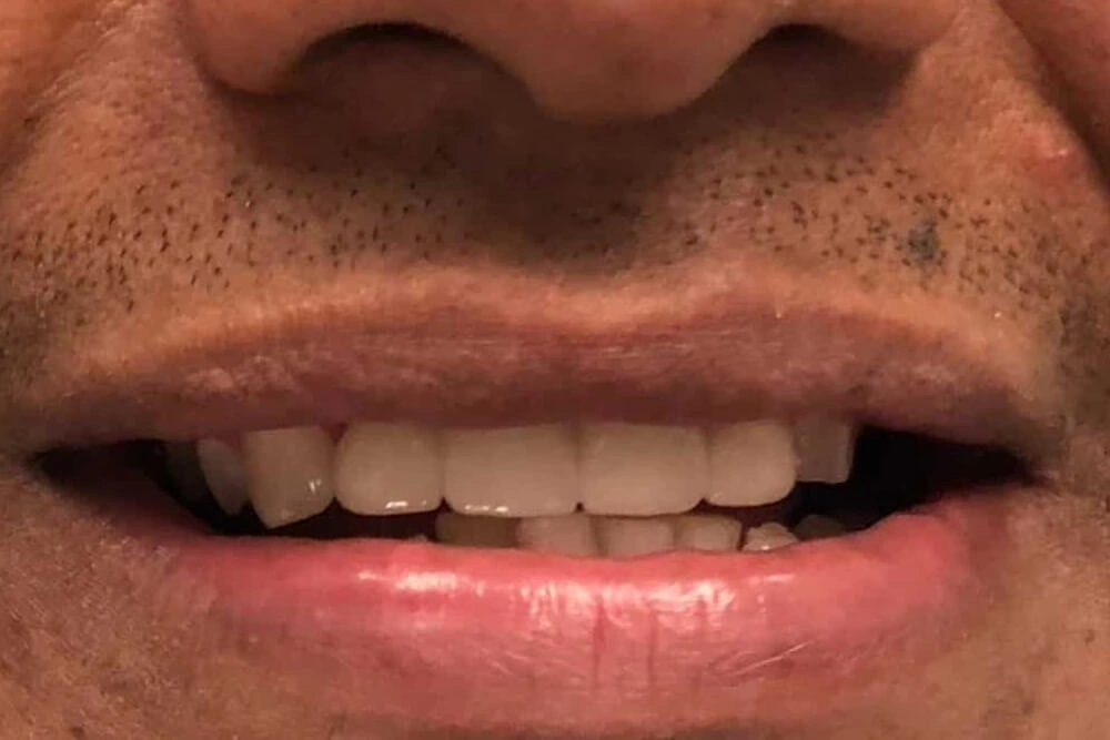 Porcelain bridge after treatment at TRU Dentistry SoCo in South Austin, TX