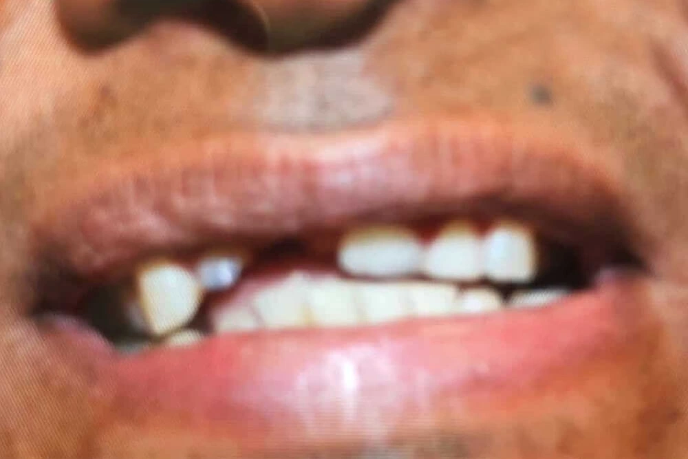Porcelain bridge before treatment at TRU Dentistry SoCo in South Austin, TX