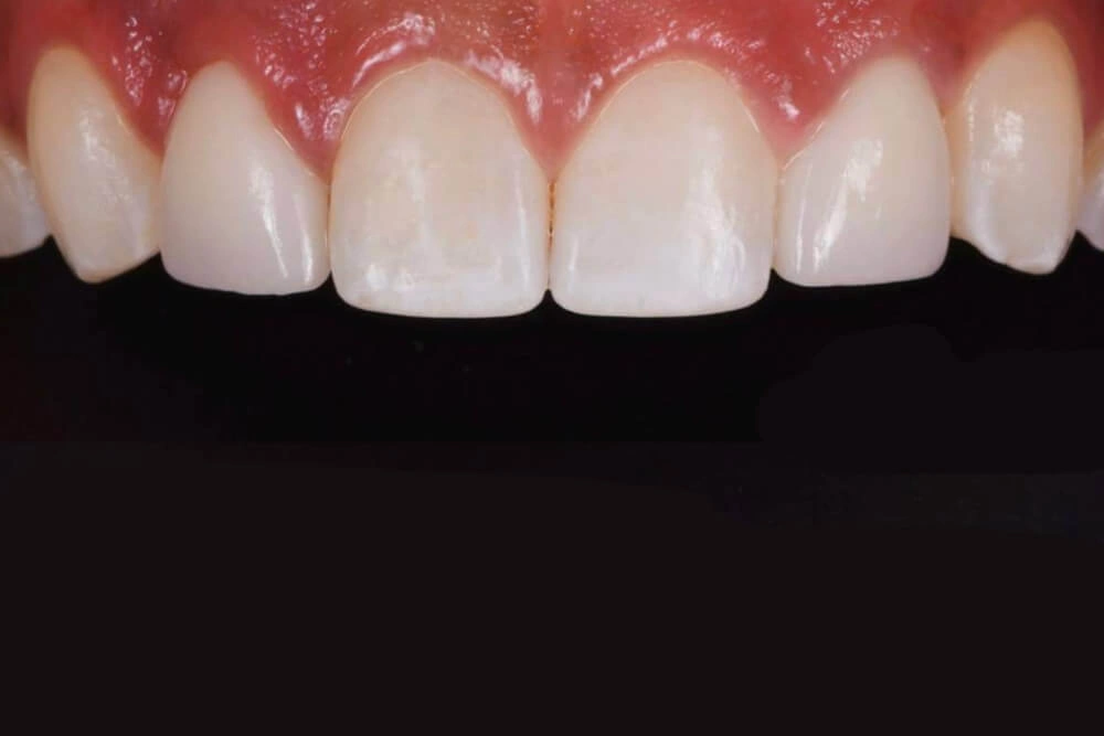 Smile gallery dental implant after treatment at TRU Dentistry SoCo in South Austin, TX