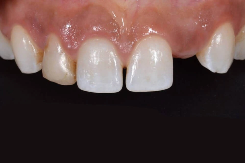 Smile gallery dental implant before treatment at TRU Dentistry SoCo in South Austin, TX