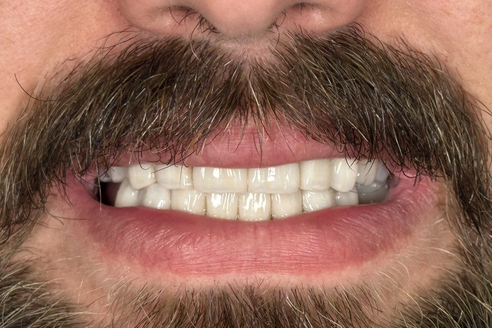 Smile gallery veneers after treatment at TRU Dentistry SoCo in South Austin, TX