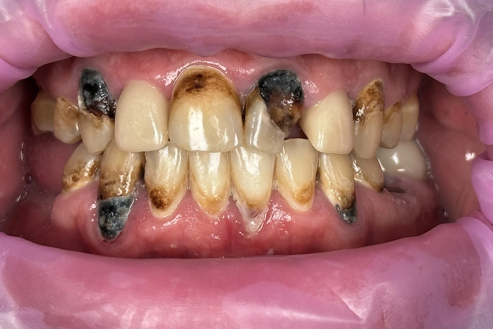 Smile gallery veneers before treatment at TRU Dentistry SoCo in South Austin, TX