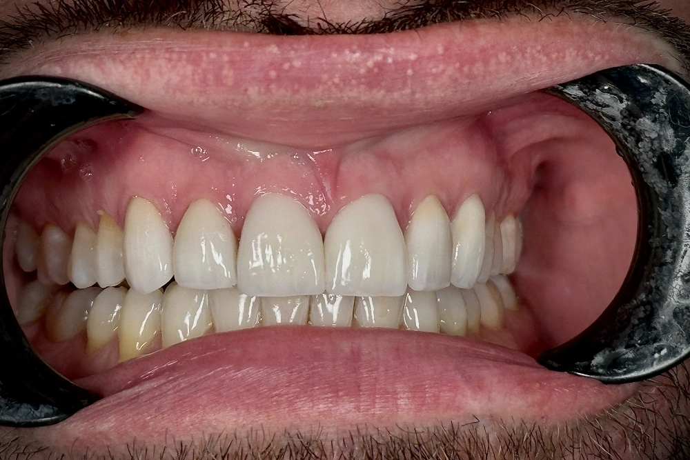 Veneers after treatment at TRU Dentistry SoCo in South Austin, TX