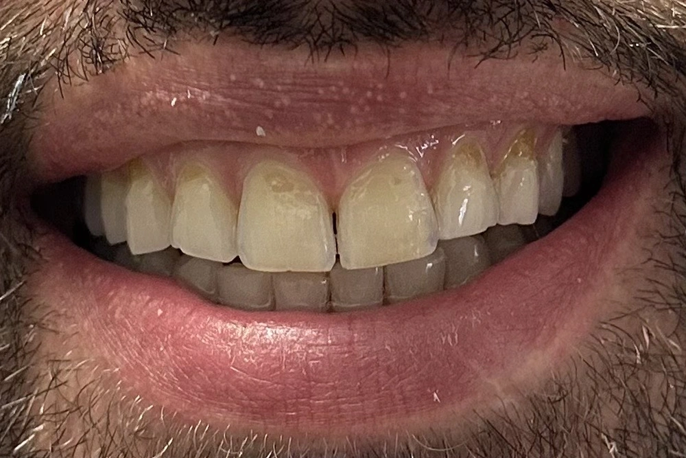 Veneers before treatment at TRU Dentistry SoCo in South Austin, TX